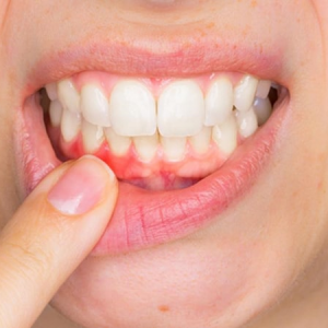 bệnh viêm lợi viêm chân răng
