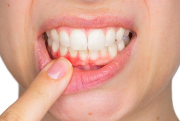 bệnh viêm lợi viêm chân răng